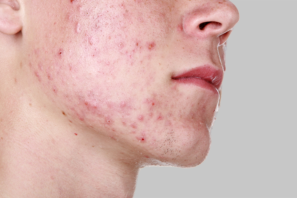 Can Acne Be Cured By Itself?