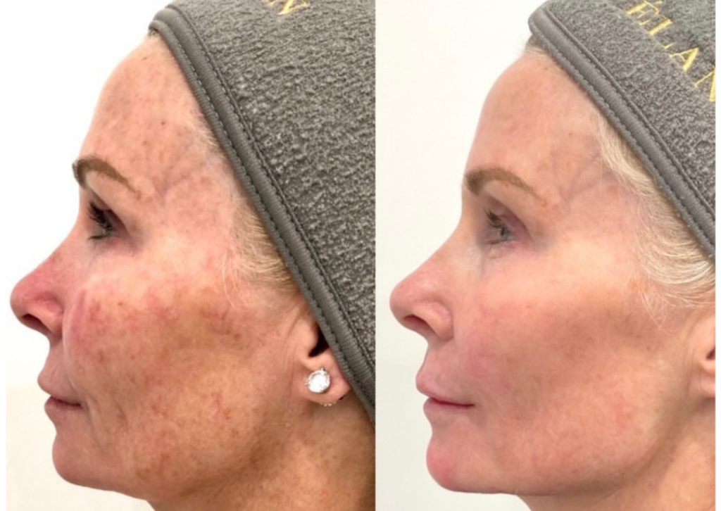 Cool Peel CO2 Laser Before and After Acne Scars
