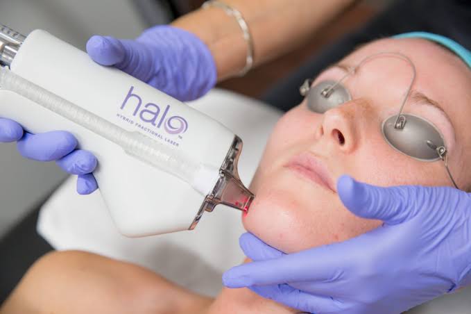 Halo laser for acne scars