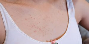 Female Chest Acne Home Remedies