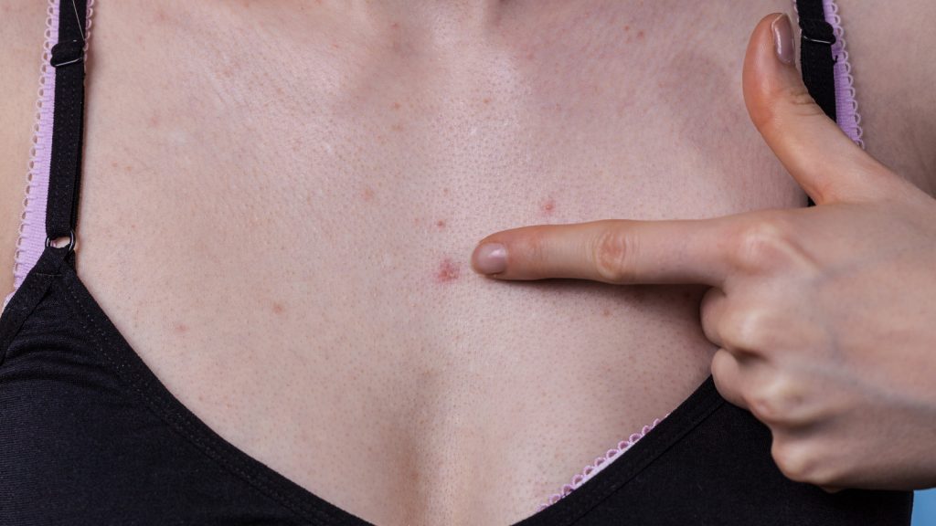 Chest Acne After Breast Augmentation