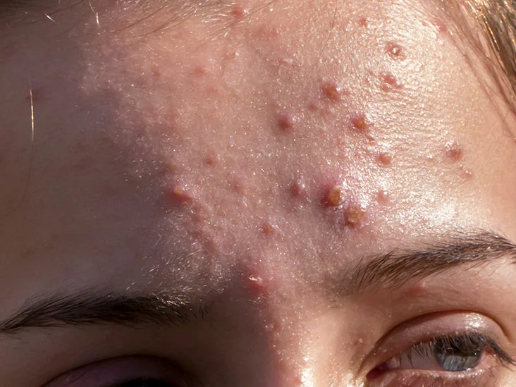 How To Tell If Acne Is Hormonal Or Bacterial