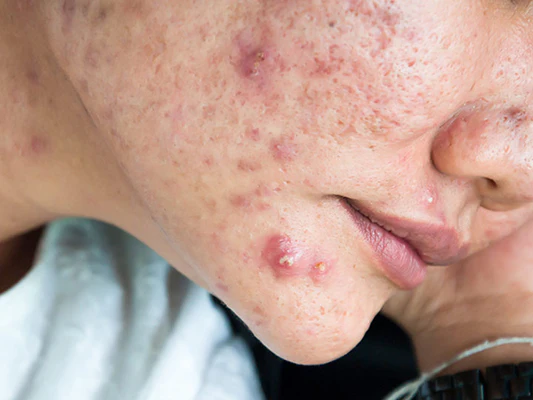 How To Tell If Acne Is Hormonal Or Bacterial