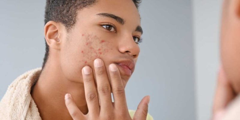 Does Maturation Cause Acne