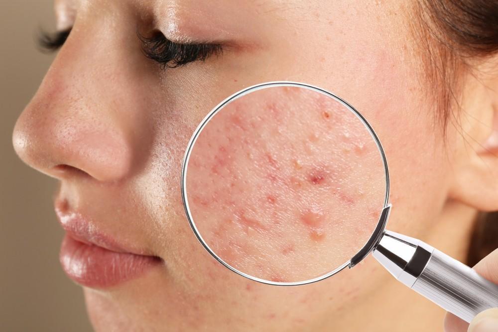 Does Maturation Cause Acne